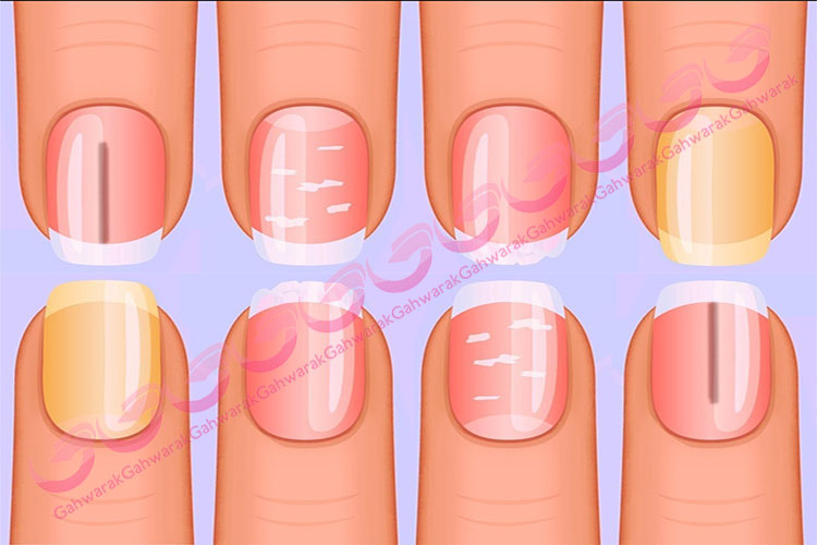 ناخن نشانه ای از سلامت کودکان لطفا اهمیت بدهید!!